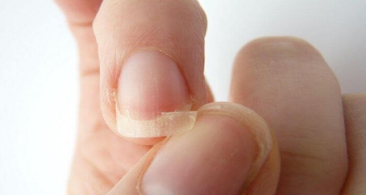 10 Remedies to Strengthen Fragile Nails